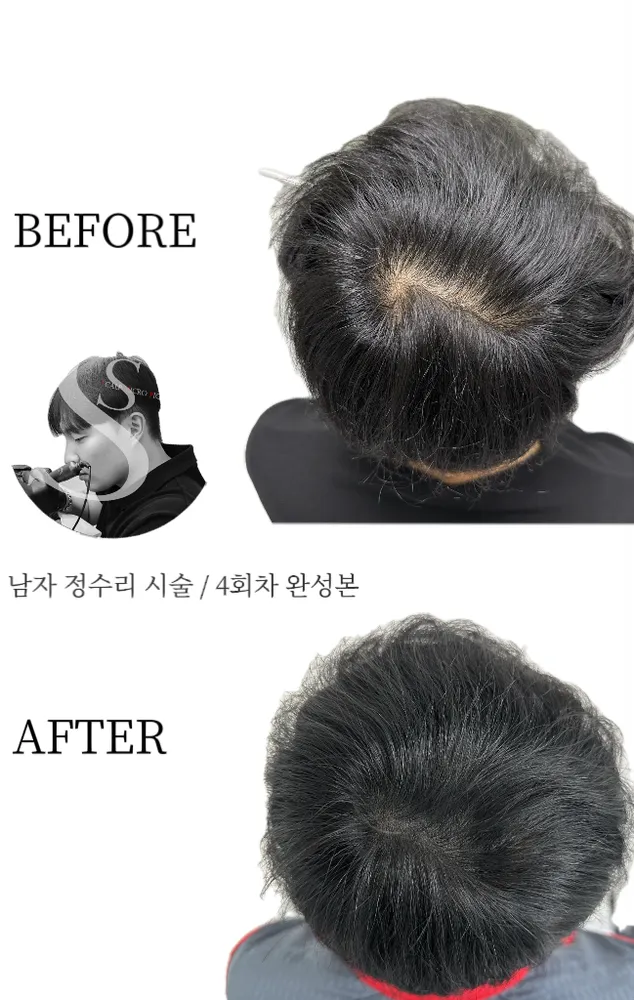 쏭스칼프 탈모 두피커버 전문점 대표 이미지