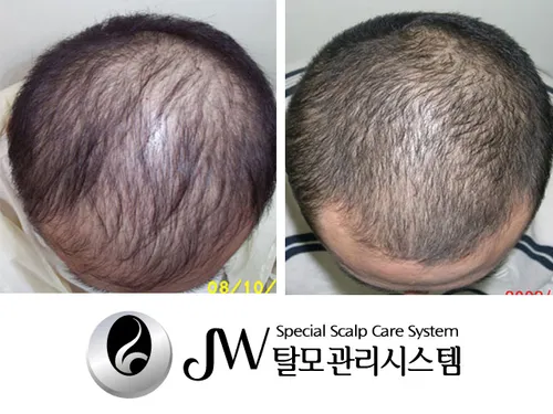 JW탈모관리센터 대표 이미지