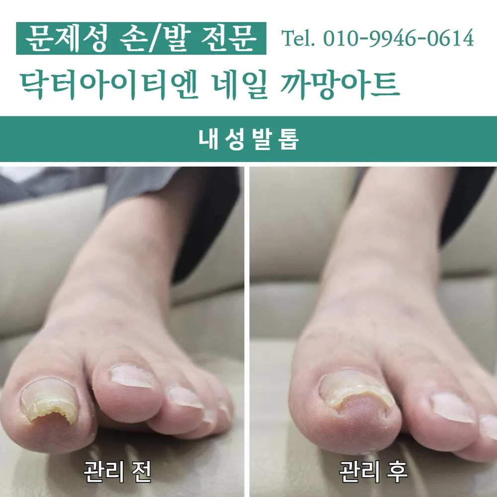 닥터아이티엔 네일 까망아트 내성발톱 무좀 발각질 문제성 대표 이미지