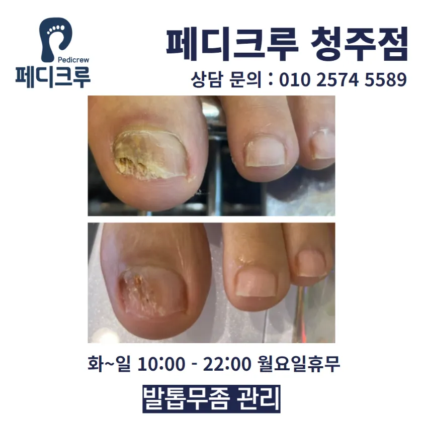 페디크루 닥터네일 발톱관리 발각질 맞춤인솔제작 대표 이미지